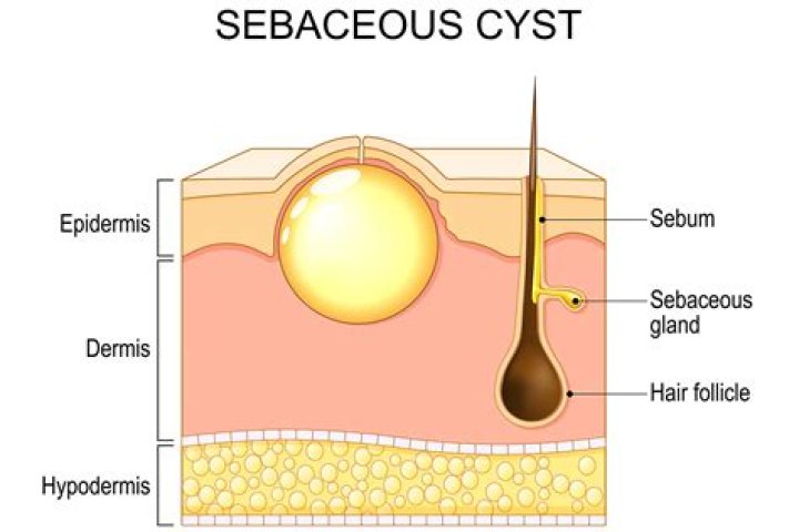 What is the cause of atheroma?
