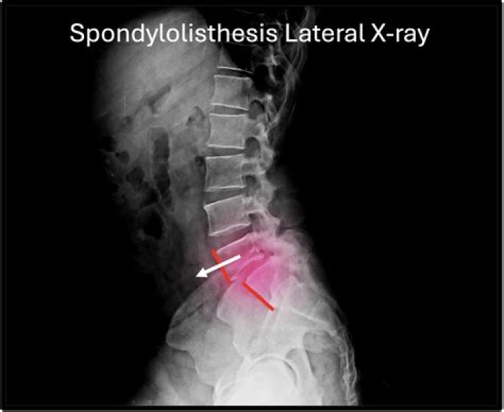 What is the difference between spondylitis and spondylolisthesis?
