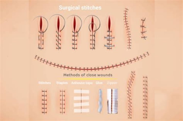 What is the glue used instead of stitches?