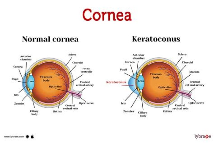 What is the medical term for surgical repair of the cornea?