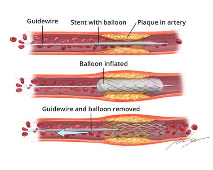 What is the removal of plaque from the inner lining of an artery?