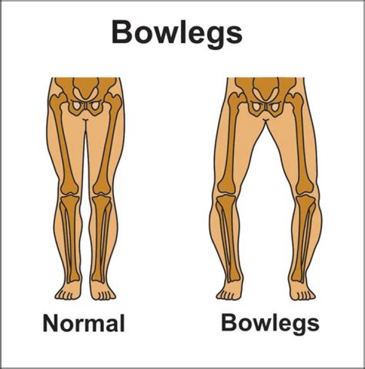 What makes a person bow legged?