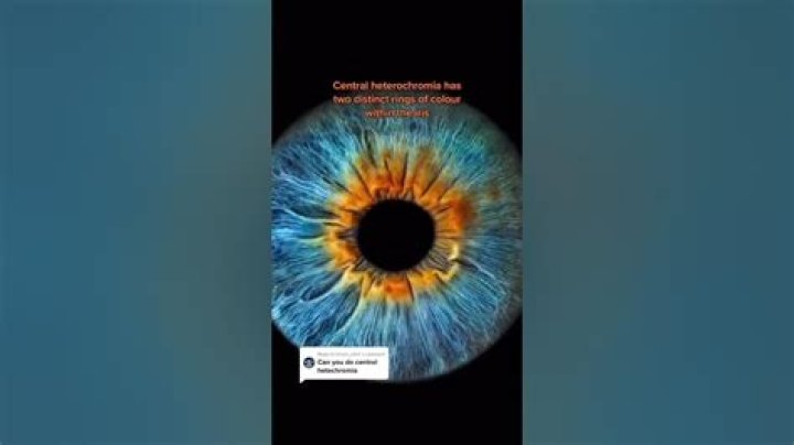 What percent of the population has central Heterochromia?