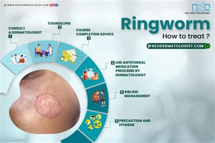 What vitamins help ringworm? | ContextResponse.com