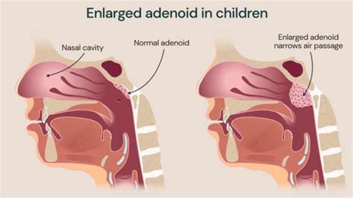 Where are adenoids and tonsils located?
