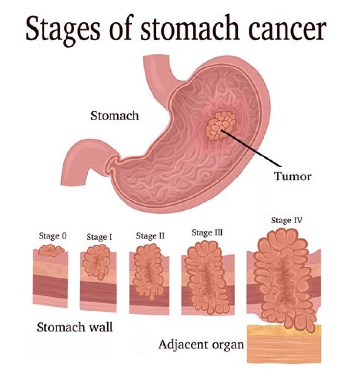 Where Does stomach cancer metastasis to?