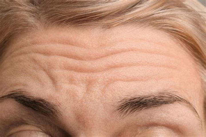 Why am I getting wrinkles on my forehead?