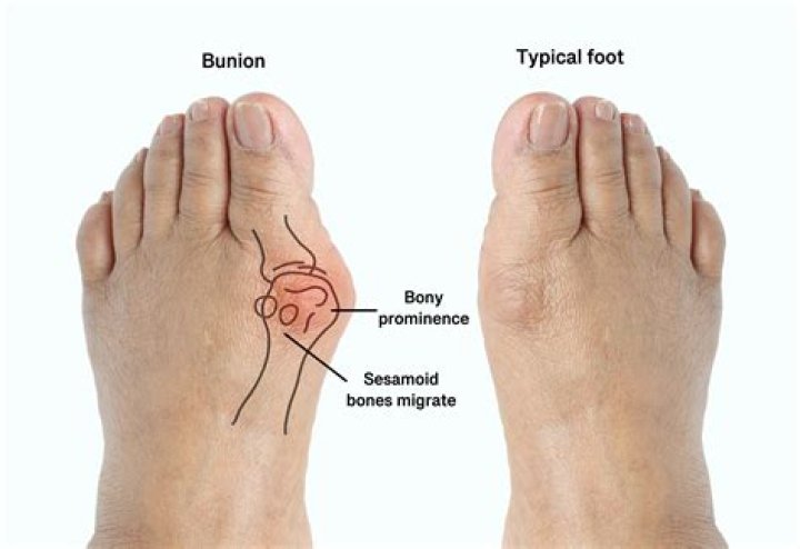 Why are bunions called bunions?