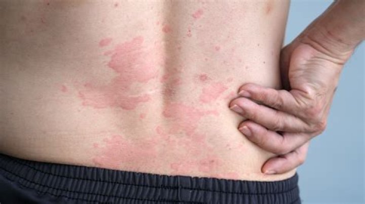 Why do hives keep appearing?