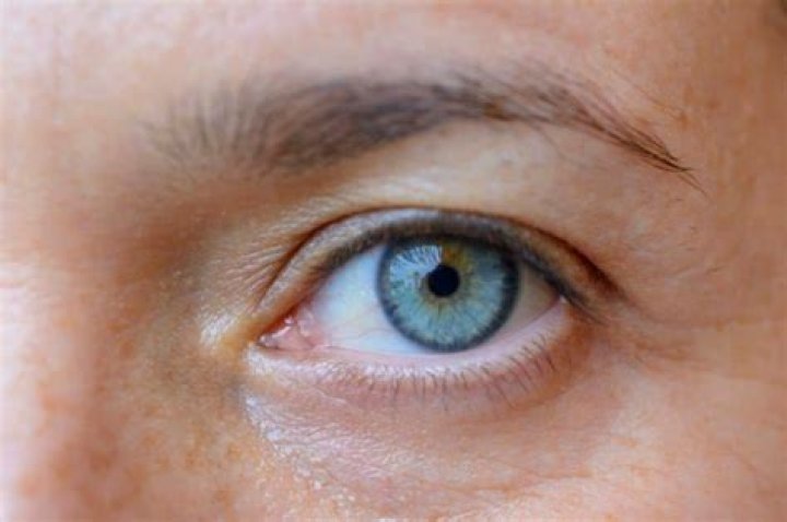 Why do I have a blue ring around my eye?