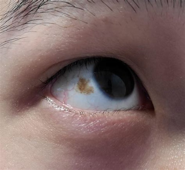 Why do I have a brown spot on my eye?