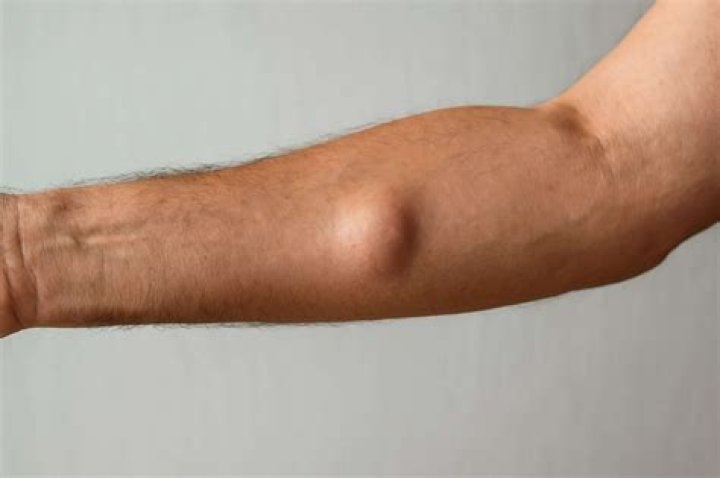 Why do I have a lump after injection?