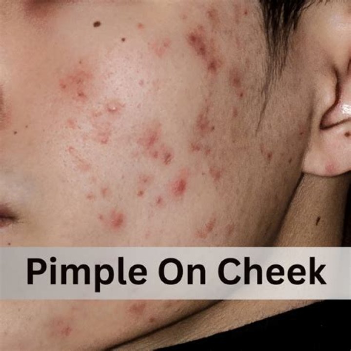 Why do my pimples get so red?