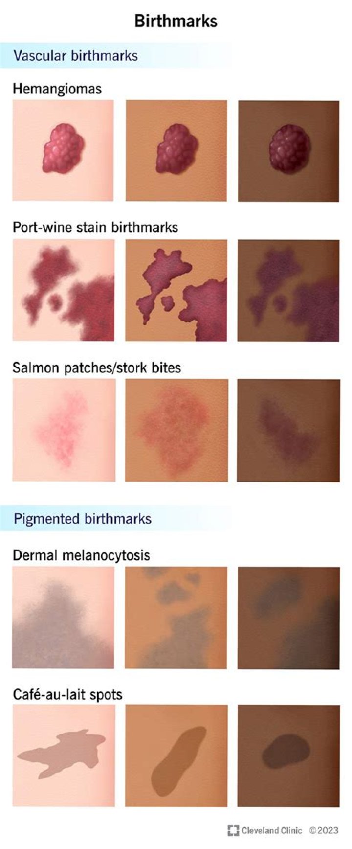 Why do they call it a birthmark?