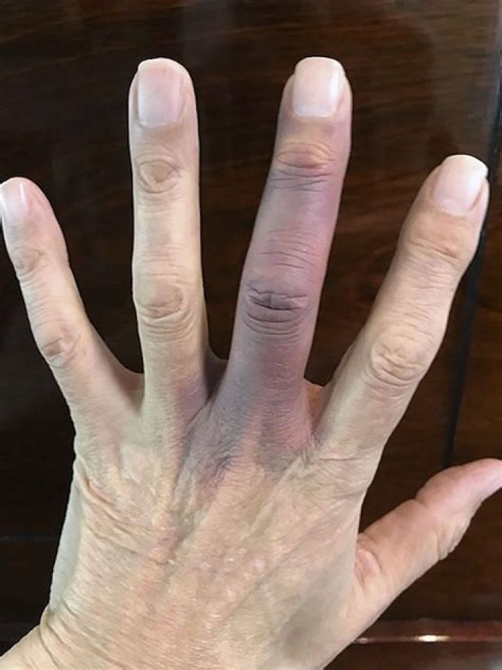 Why does my finger look bruised?