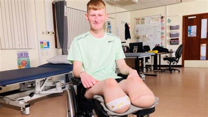 Why would a leg need to be amputated?