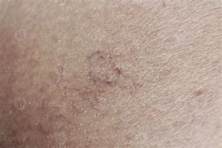 Will a picked scab scar?