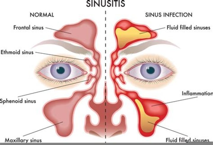 Will a sinus rinse cure a sinus infection?